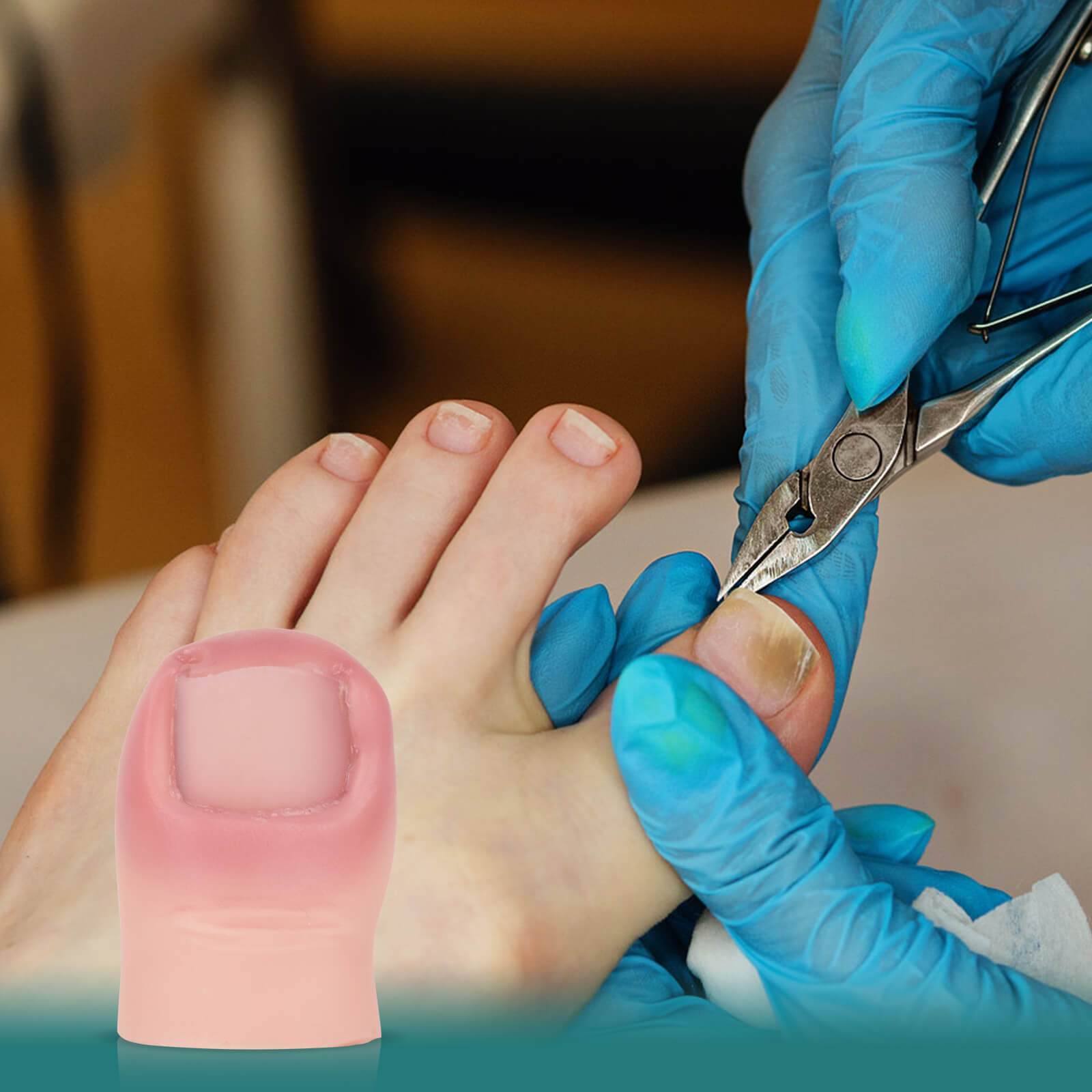 Ingrown Toenail Removal Training Model with Replaceable Toenail